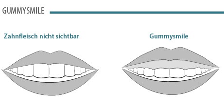 gummy-smile-01.png 