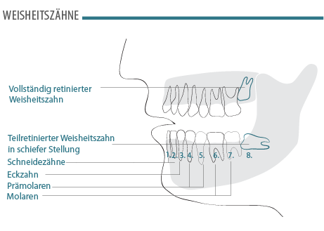 weisheitszaehne-1.png