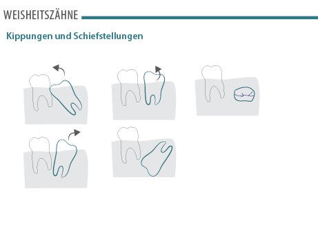weisheitszaehne-2.png