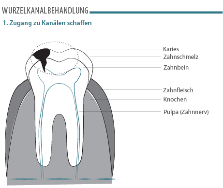 wurzelkanalbehandlung-1.png 