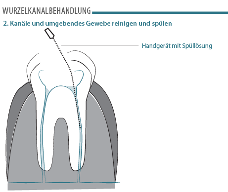 wurzelkanalbehandlung-2.png
