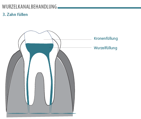 wurzelkanalbehandlung-3.png